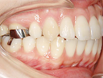 出っ歯上顎前突　舌側矯正（治療中）