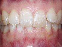 過蓋咬合　下顎前歯一歯欠損　舌側矯正（治療前）