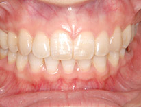 過蓋咬合　下顎前歯一歯欠損　舌側矯正（治療後）