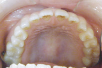 すきっ歯（治療前）